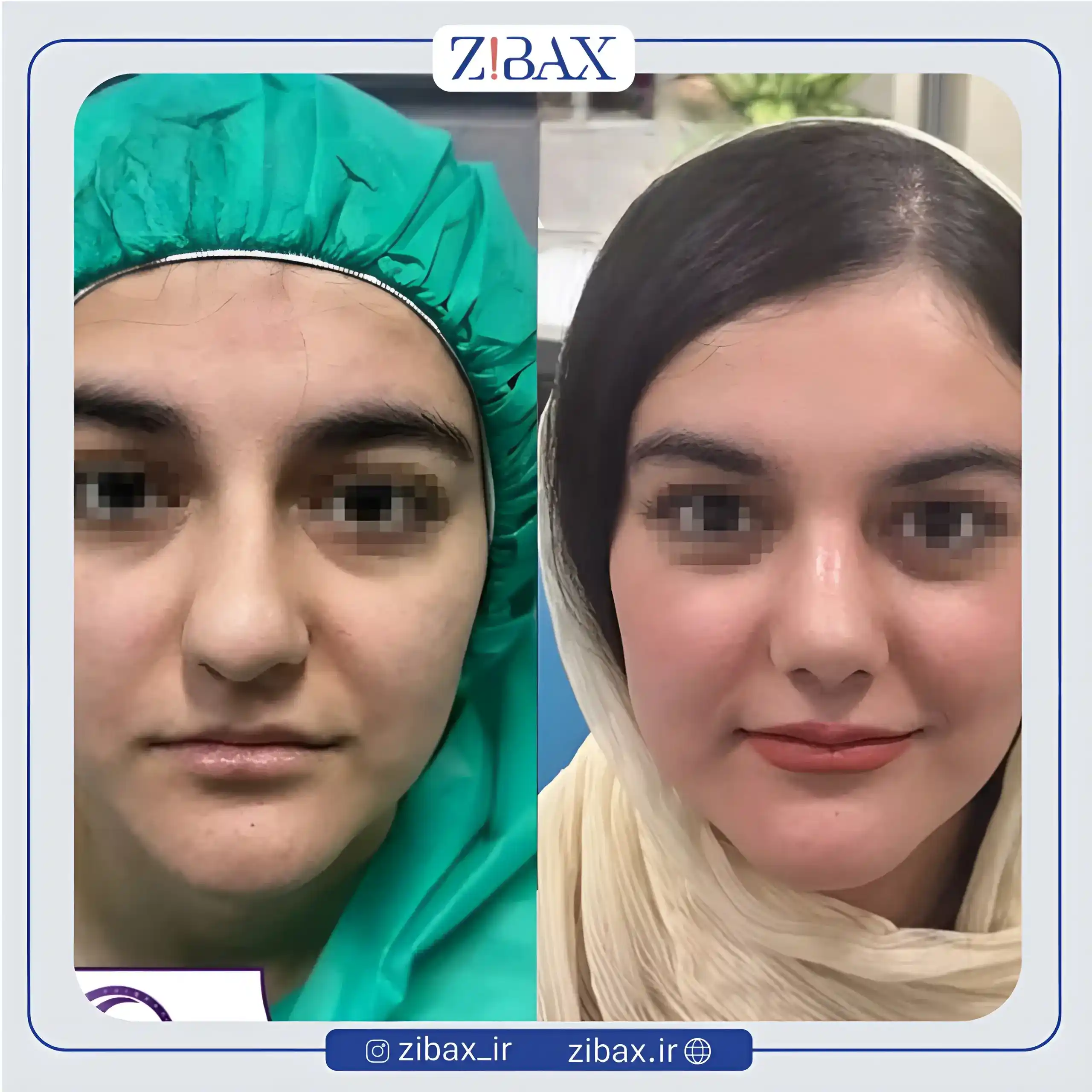 نمونه عمل جراحی بینی دکتر فرشید شکوهی — تصویر 1