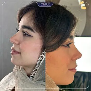 نمونه عمل جراحی بینی دکتر لیلا ملکی — تصویر 2