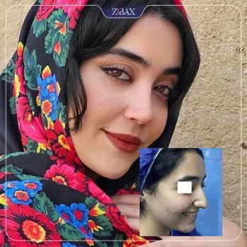 نمونه عمل جراحی بینی دکتر لیلا ملکی — تصویر 3