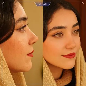 نمونه عمل جراحی بینی دکتر لیلا ملکی — تصویر 5