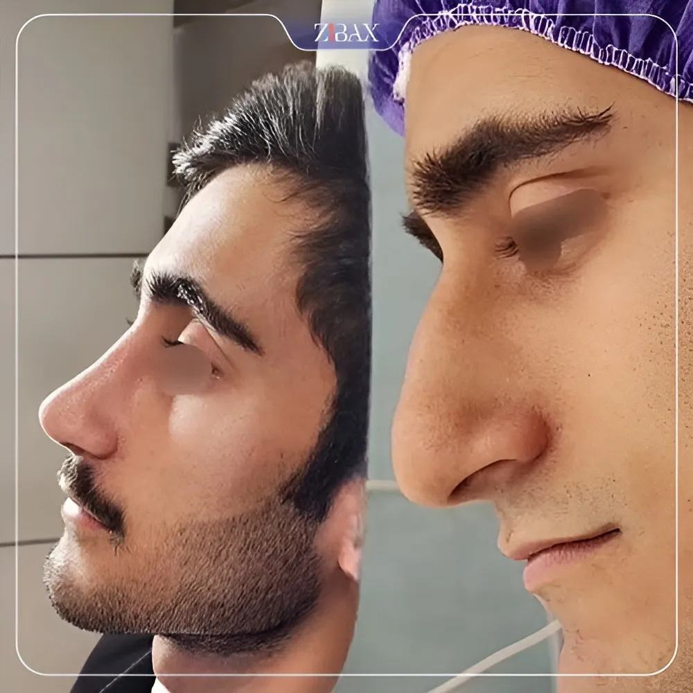 نمونه عمل جراحی بینی دکتر شمیلا رضوانی نیا — تصویر 6