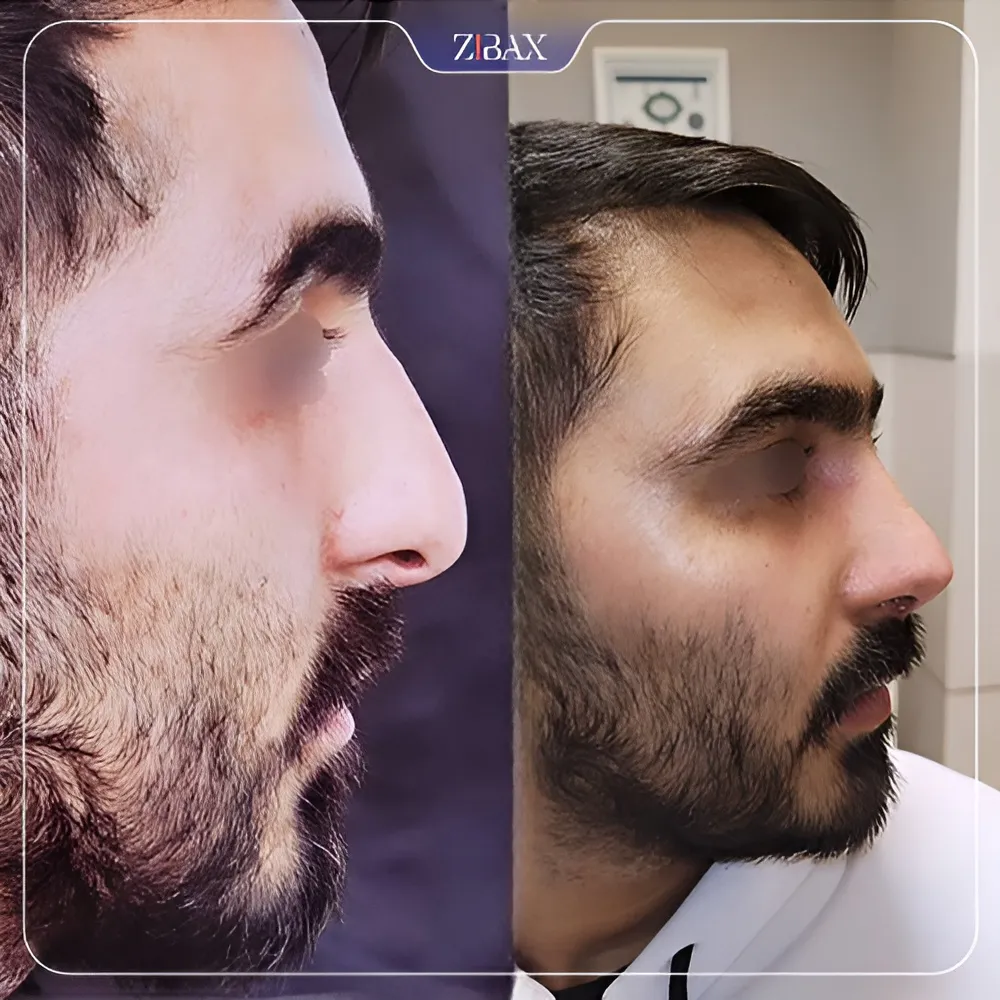 نمونه عمل جراحی بینی دکتر شمیلا رضوانی نیا — تصویر 8