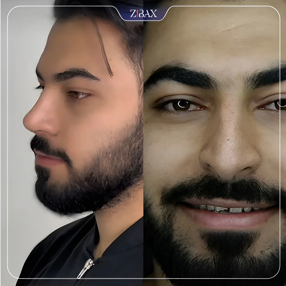 نمونه عمل جراحی بینی دکتر لطفعلی نوروزی — تصویر 2