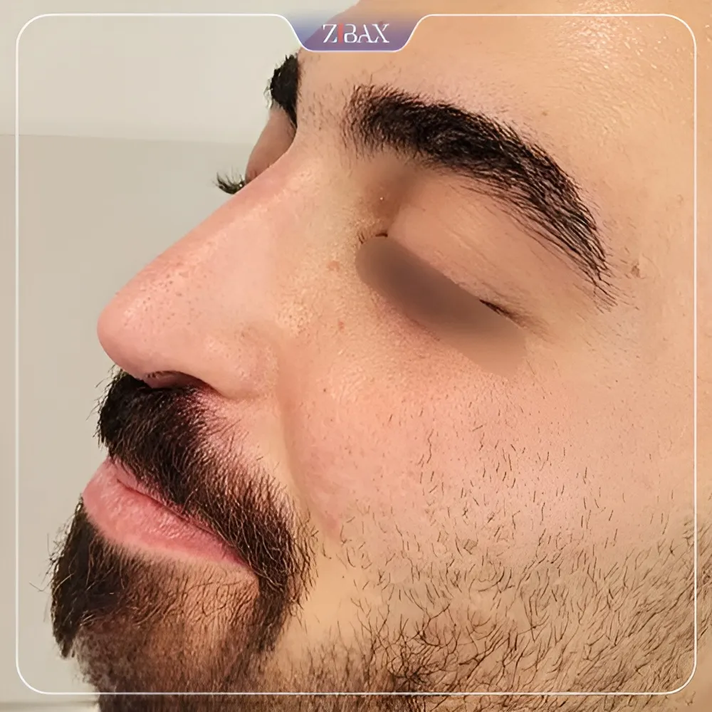 نمونه عمل جراحی بینی دکتر شمیلا رضوانی نیا — تصویر 2