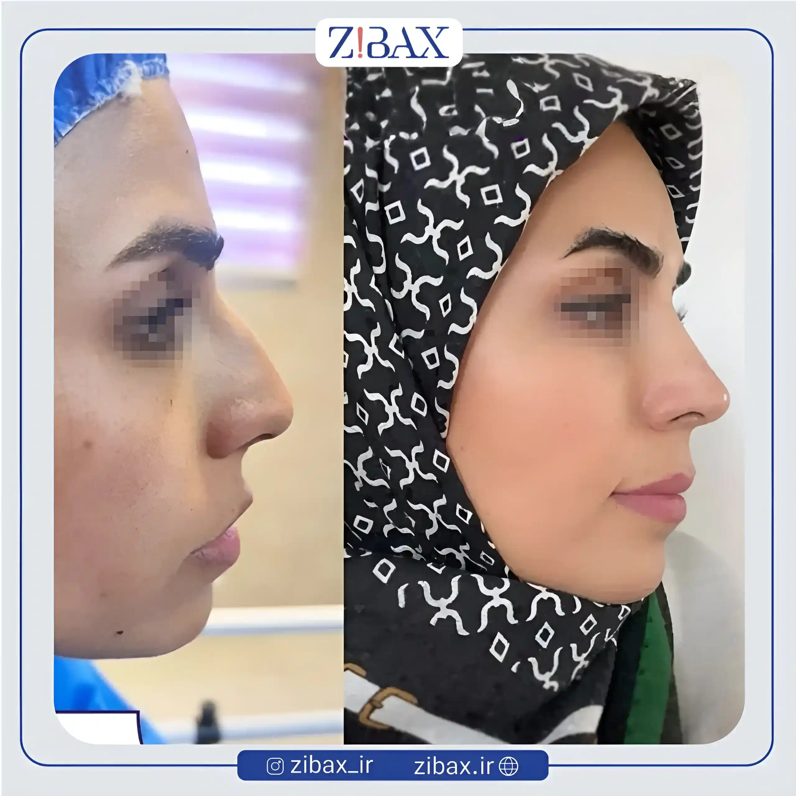 نمونه عمل جراحی بینی دکتر فرشید شکوهی — تصویر 4