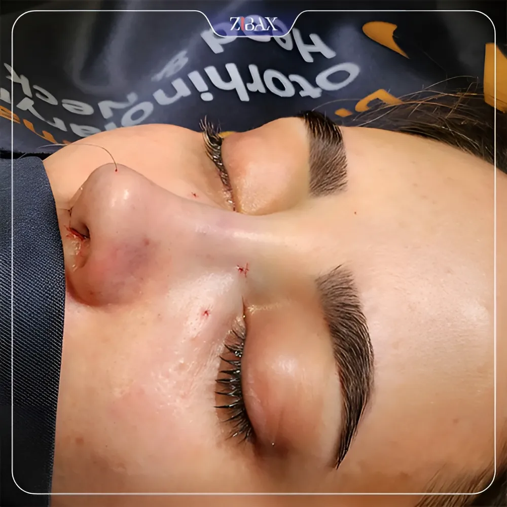 نمونه عمل جراحی بینی دکتر محمد صفری کمال آبادی — تصویر 4