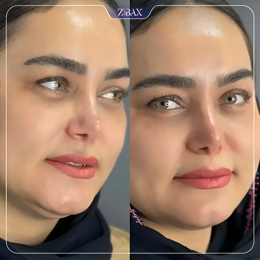 نمونه عمل جراحی بینی دکتر لطفعلی نوروزی — تصویر 5