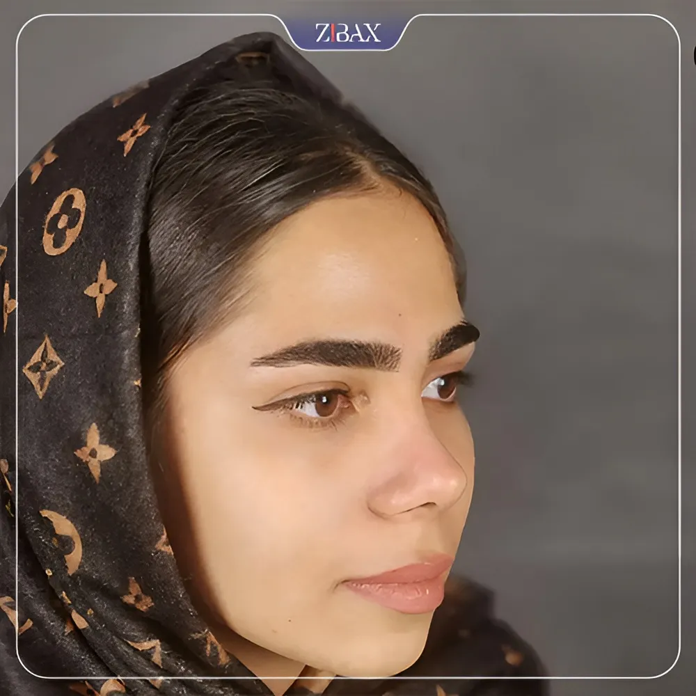 نمونه عمل جراحی بینی دکتر محمد صفری کمال آبادی — تصویر 8