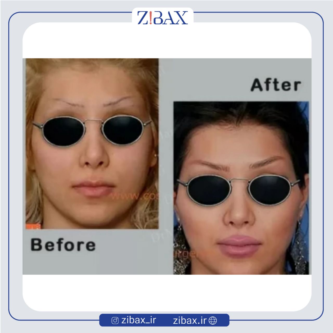 نمونه عمل جراحی بینی دکتر علی منافی — تصویر 2
