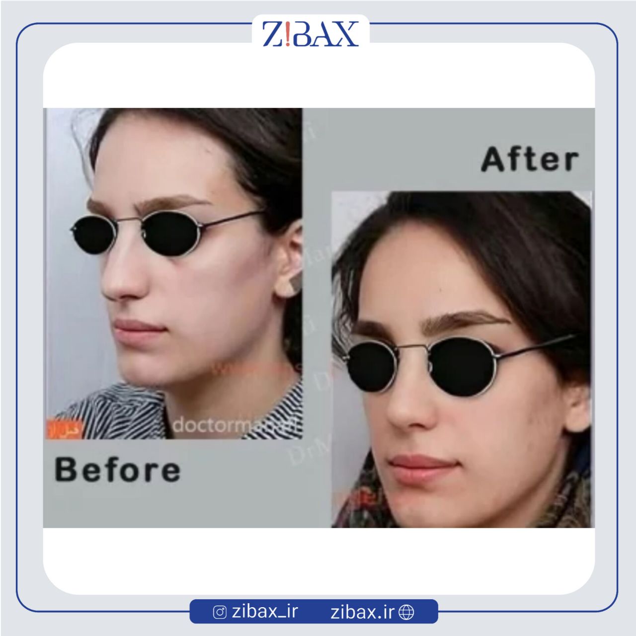 نمونه عمل جراحی بینی دکتر علی منافی — تصویر 3