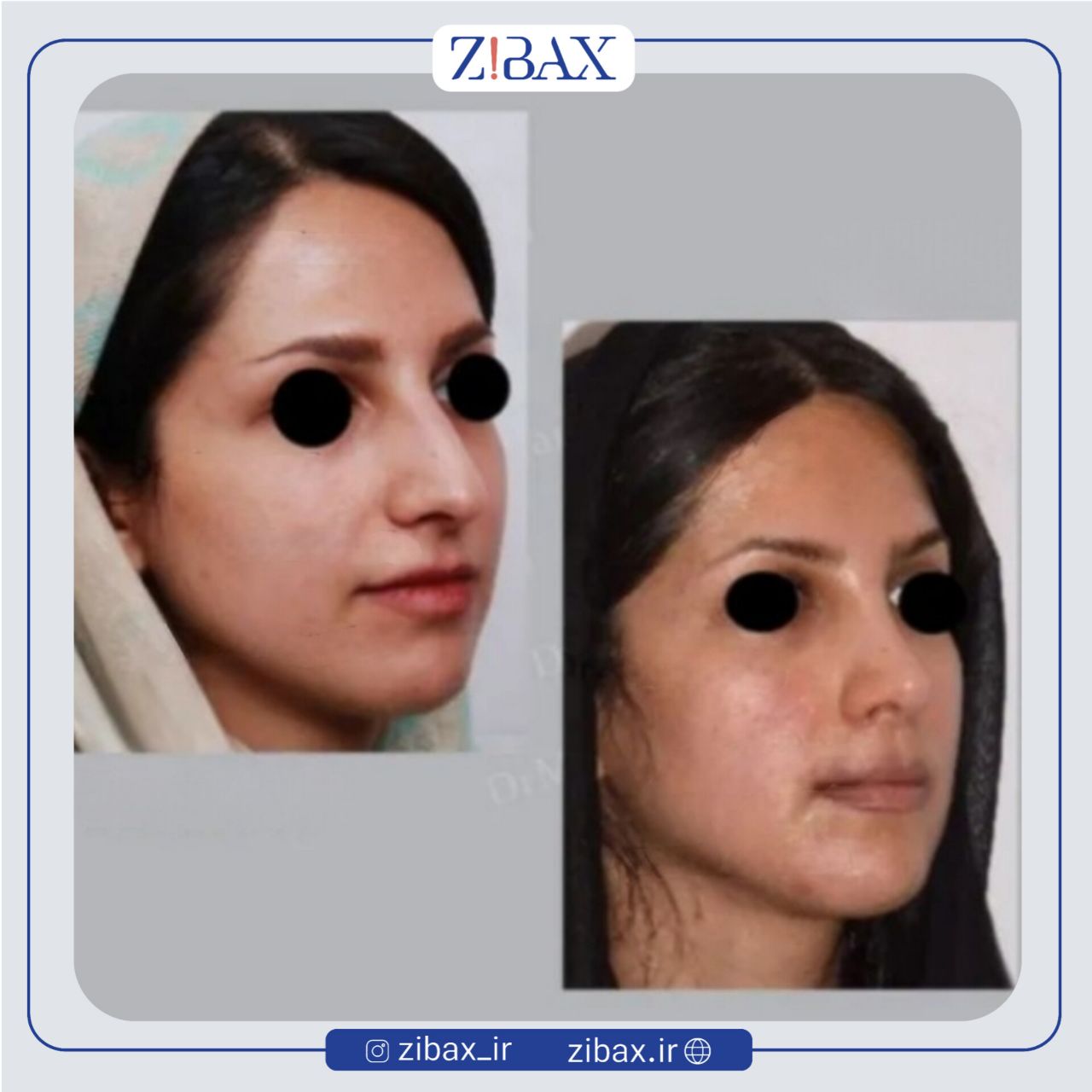 نمونه عمل جراحی بینی دکتر علی منافی — تصویر 4
