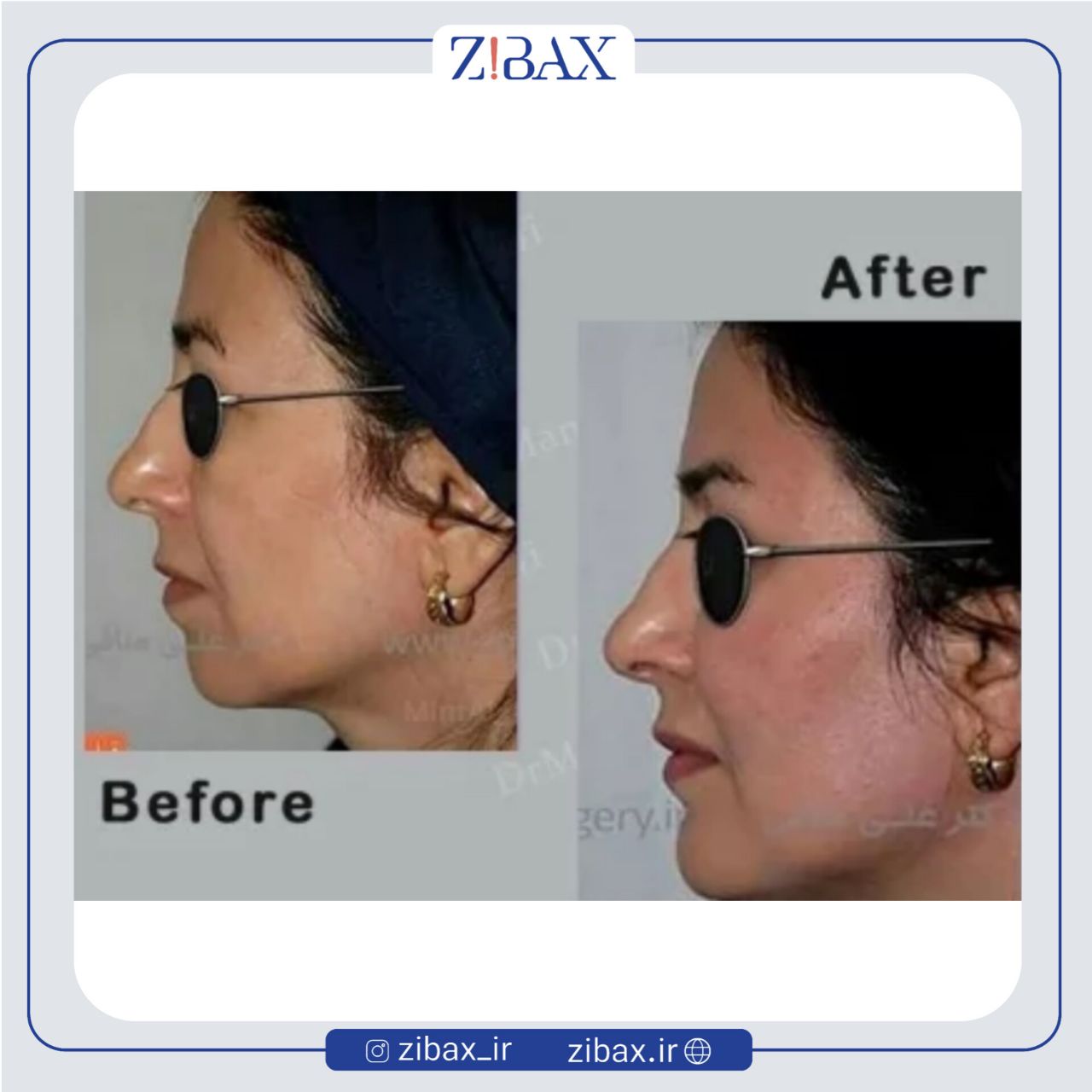 نمونه عمل جراحی بینی دکتر علی منافی — تصویر 7