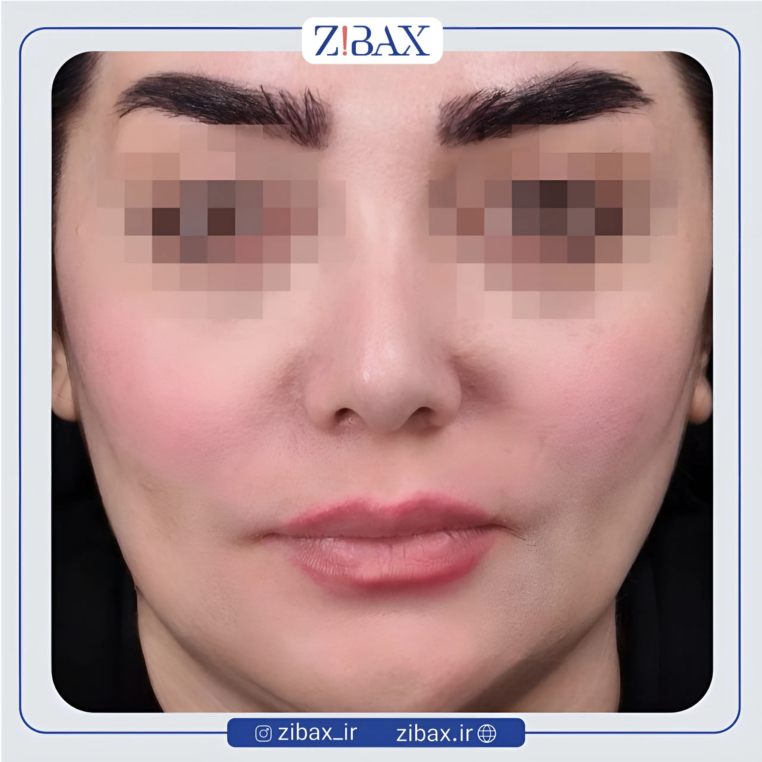 نمونه عمل جراحی بینی دکتر امیر دریانی — تصویر 5