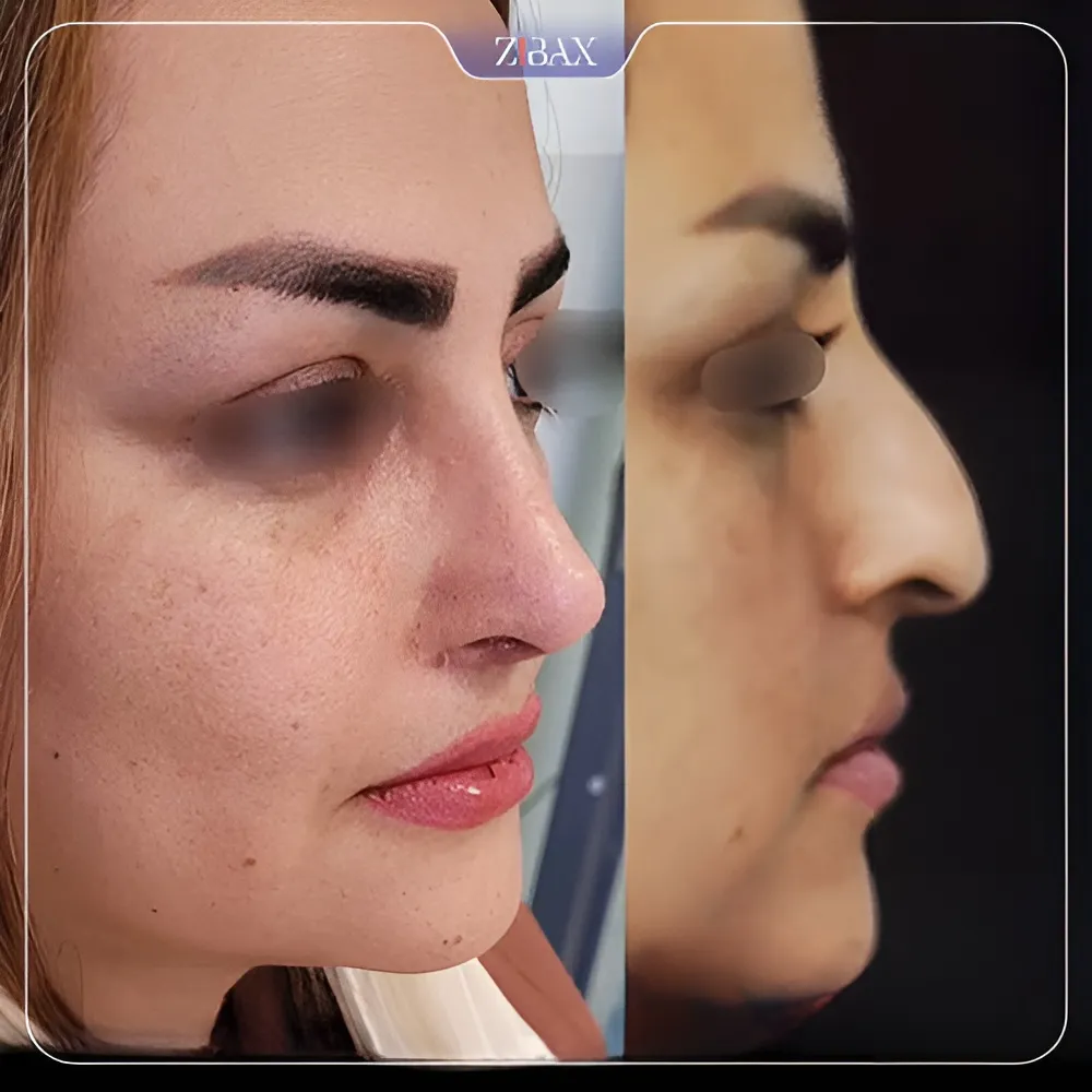 نمونه عمل جراحی بینی دکتر شمیلا رضوانی نیا — تصویر 3