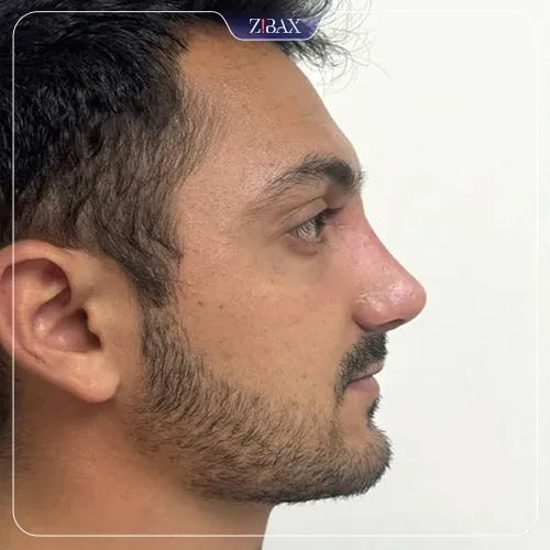نمونه عمل جراحی بینی دکتر ادیب ملائی — تصویر 6