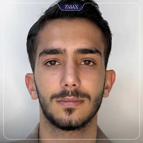 نمونه عمل جراحی بینی دکتر ادیب ملائی — تصویر 5