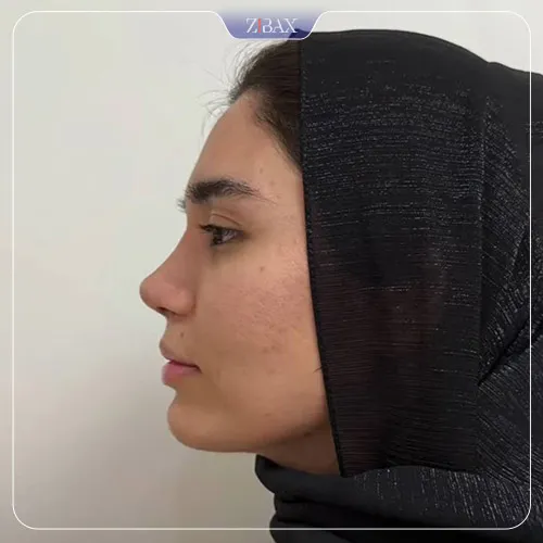 نمونه عمل جراحی بینی دکتر ادیب ملائی — تصویر 2