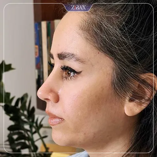 نمونه عمل جراحی بینی دکتر علیرضا مصباحی — تصویر 10