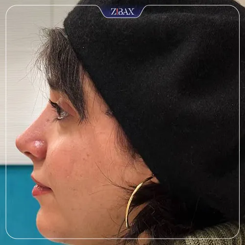 نمونه عمل جراحی بینی دکتر علیرضا مصباحی — تصویر 1