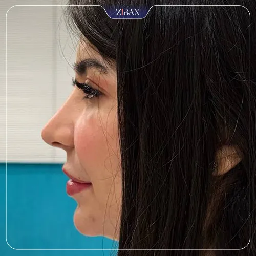 نمونه عمل جراحی بینی دکتر علیرضا مصباحی — تصویر 2