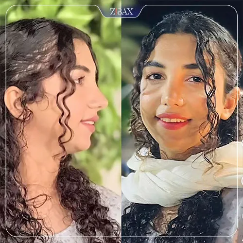 نمونه عمل جراحی بینی دکتر محمد مهدی ده بزرگی — تصویر 4