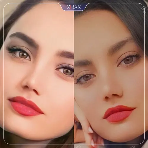 نمونه عمل جراحی بینی دکتر محمد مهدی ده بزرگی — تصویر 7