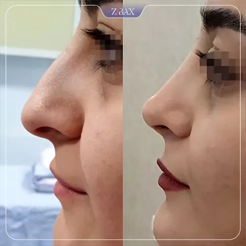 نمونه عمل جراحی بینی دکتر محمد مهدی ده بزرگی — تصویر 8