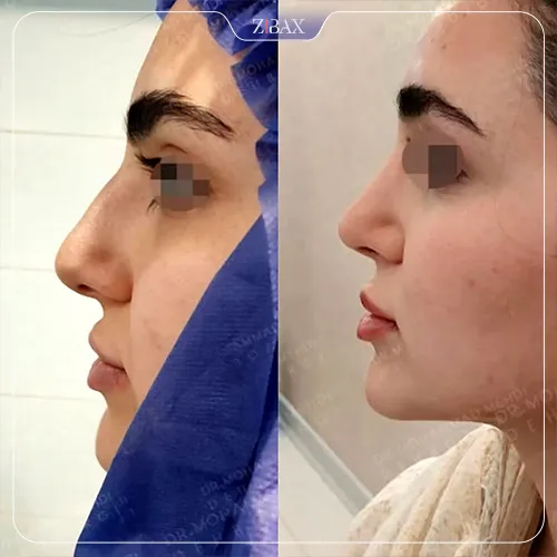 نمونه عمل جراحی بینی دکتر محمد مهدی ده بزرگی — تصویر 1