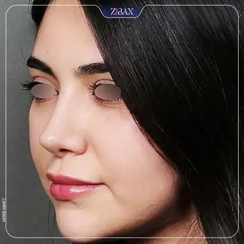 نمونه عمل جراحی بینی دکتر شهریار یحیوی — تصویر 7