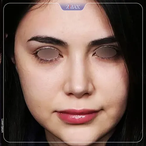نمونه عمل جراحی بینی دکتر شهریار یحیوی — تصویر 5