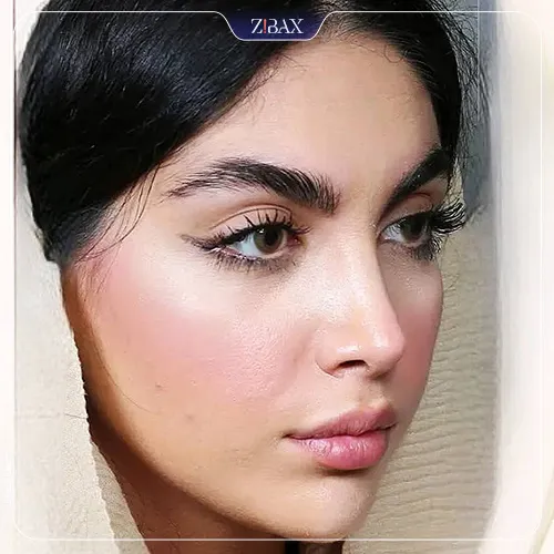نمونه عمل جراحی بینی دکتر شهریار یحیوی — تصویر 3