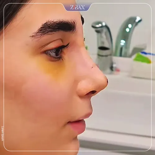 نمونه عمل جراحی بینی دکتر شهریار یحیوی — تصویر 4