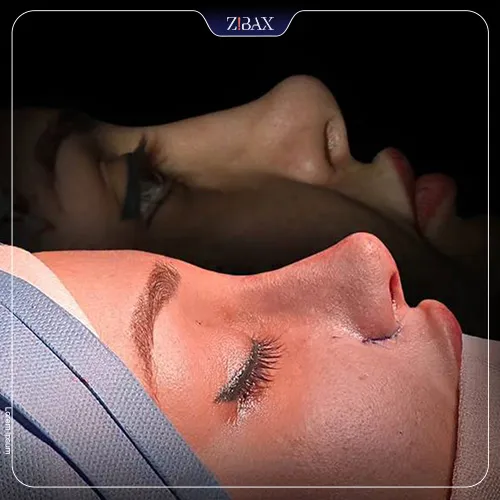 نمونه عمل جراحی بینی دکتر شهریار یحیوی — تصویر 1