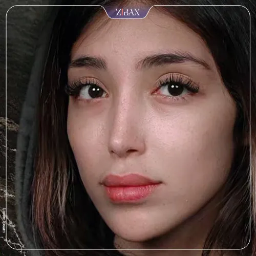 نمونه عمل جراحی بینی دکتر شهریار یحیوی — تصویر 10