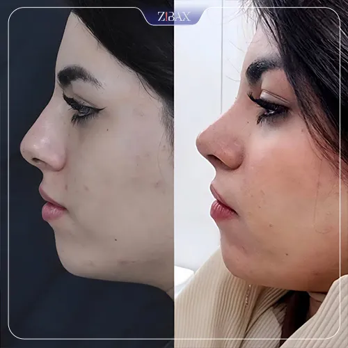 نمونه عمل جراحی بینی دکتر لیلا شریفی — تصویر 5