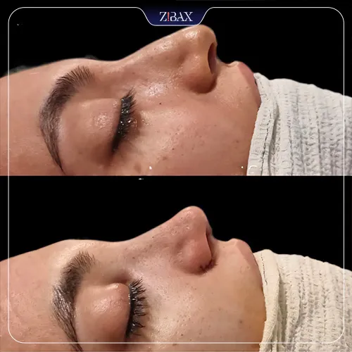 نمونه عمل جراحی بینی دکتر لیلا شریفی — تصویر 2