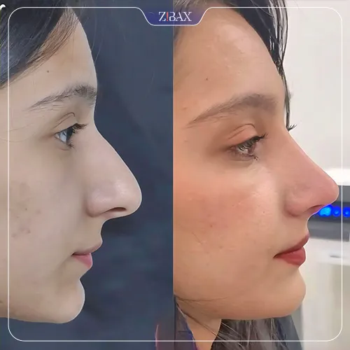 نمونه عمل جراحی بینی دکتر لیلا شریفی — تصویر 1