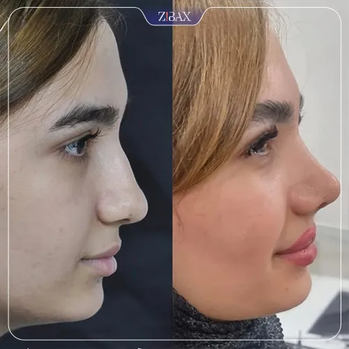 نمونه عمل جراحی بینی دکتر لیلا شریفی — تصویر 7