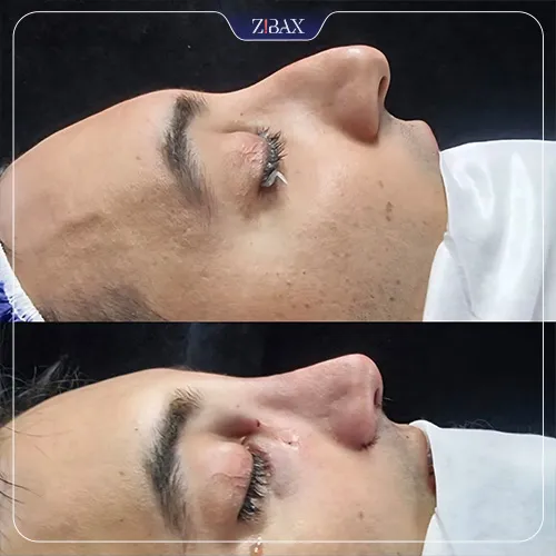 نمونه عمل جراحی بینی دکتر لیلا شریفی — تصویر 8