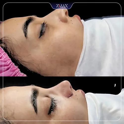 نمونه عمل جراحی بینی دکتر لیلا شریفی — تصویر 6