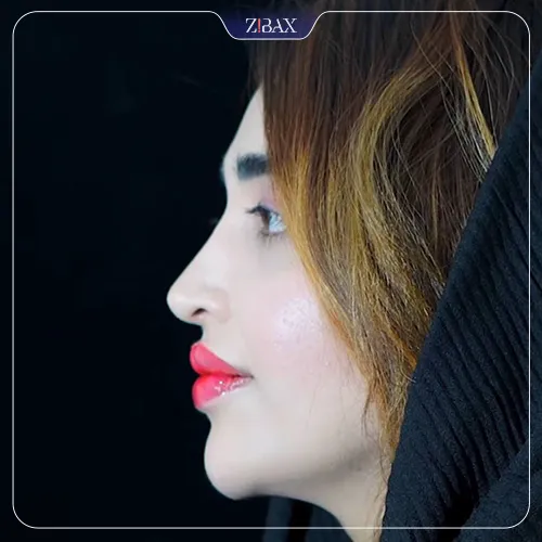 نمونه عمل جراحی بینی دکتر ابراهیم حاتمی پور — تصویر 9