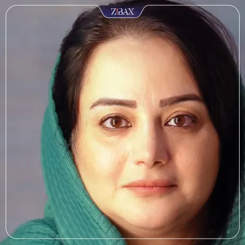 نمونه عمل جراحی بینی دکتر ابراهیم حاتمی پور — تصویر 8