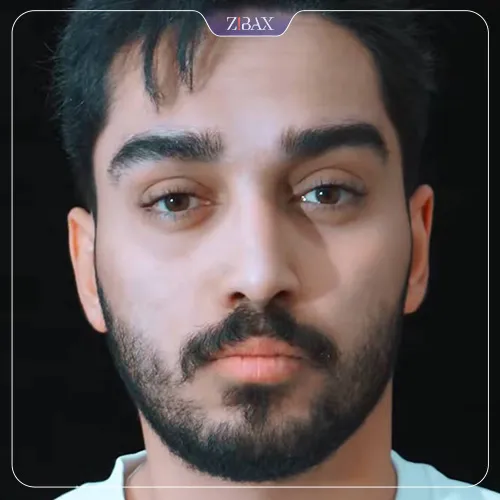 نمونه عمل جراحی بینی دکتر ابراهیم حاتمی پور — تصویر 2