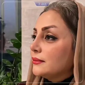 نمونه عمل جراحی بینی دکتر رویا جاویدی — تصویر 6