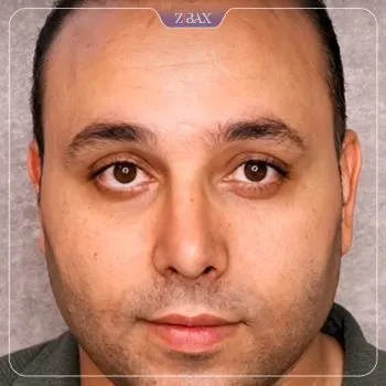 نمونه عمل جراحی بینی دکتر رویا جاویدی — تصویر 10