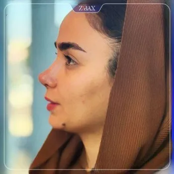 نمونه عمل جراحی بینی دکتر رویا جاویدی — تصویر 1
