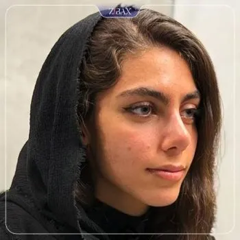 نمونه عمل جراحی بینی دکتر رویا جاویدی — تصویر 2