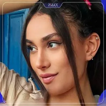نمونه عمل جراحی بینی دکتر رویا جاویدی — تصویر 4