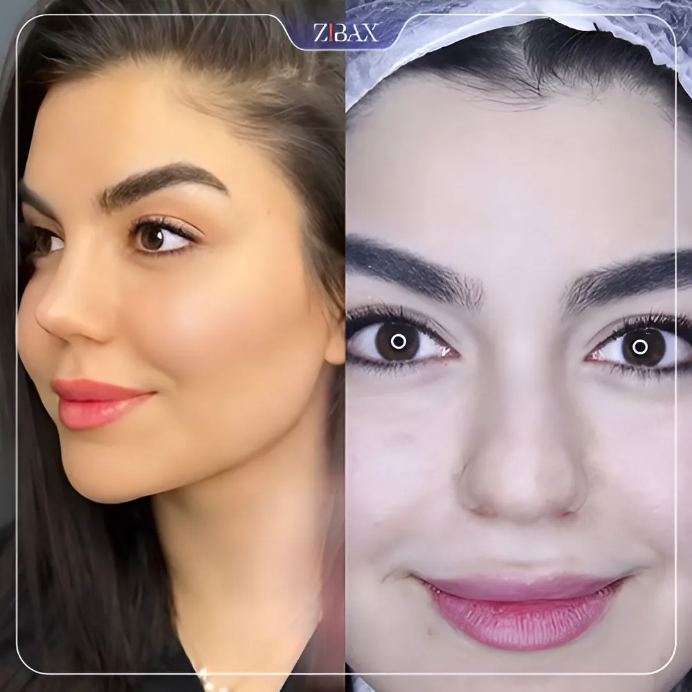 نمونه عمل جراحی بینی دکتر لطفعلی نوروزی — تصویر 7
