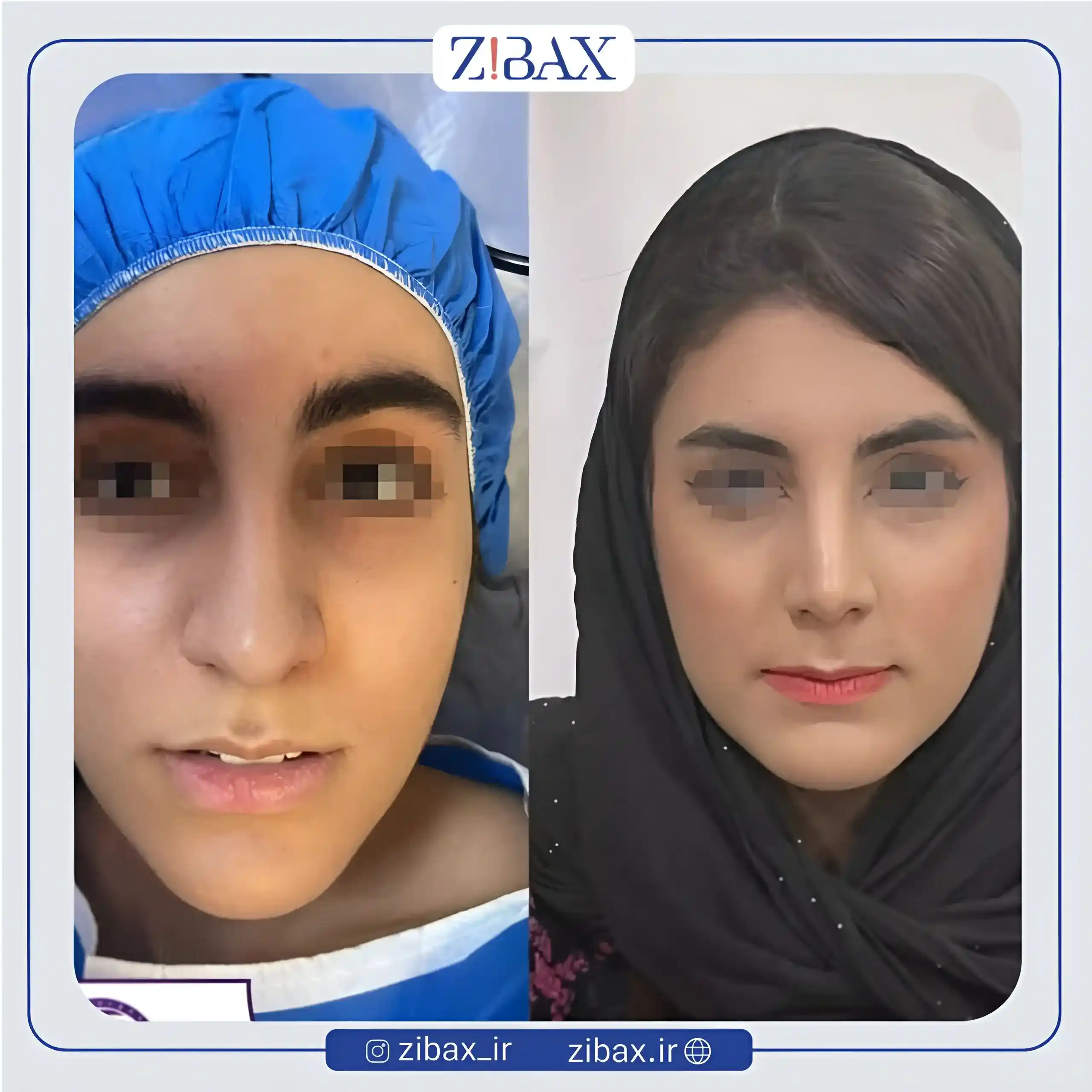 نمونه عمل جراحی بینی دکتر فرشید شکوهی — تصویر 7